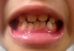 下の前歯2本 前から1番目の前歯 が永久歯に生え変わりましたが二本ともハの字のように曲がって生えていたため抜歯しました 写真あり 太田矯正歯科クリニック 和歌山県和歌山市