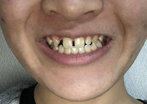 顎がないのが気になるのですが 矯正をすれば改善されるのでしょうか 写真あり 太田矯正歯科クリニック 和歌山県和歌山市